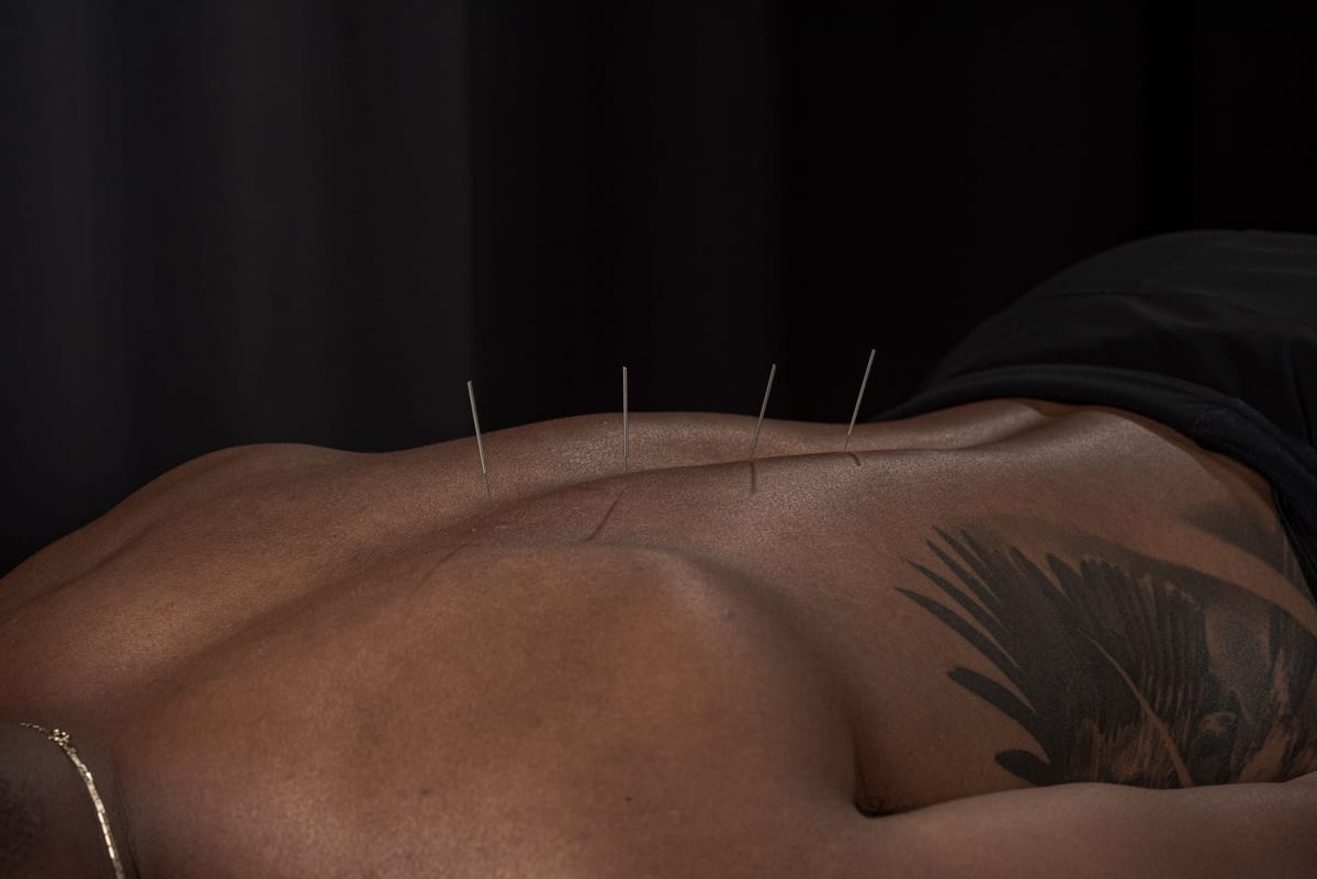 Fine needles placed along a patient's back during a dry needling session at the clinic
